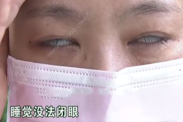 女子做整容手术后眼睛无法合上！睡觉只能翻白眼贴胶带！(2)