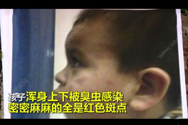 幼儿遭臭虫咬伤获赔1000万！遭到虫子咬怎么急救？(4)