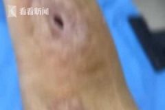 男子杀鱼时不小心划伤手指，几个月后右手手臂被"蛀空"[多图]