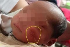 剖宫产婴儿脸部被割伤缝8针，手术医生被停职[多图]